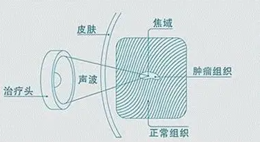 超声肿瘤治疗