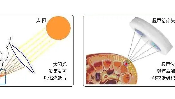 超声波治疗的机理是什么？听声峰超声波厂家给你分析